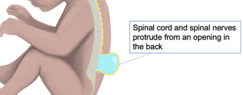 <p>a neural tube defect where the backbone and spinal canal fail to close before birth, causing a fluid-filled sac containing parts of the spinal cord and nerves to protrude through the baby's back</p>