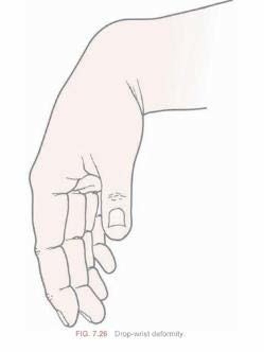 <p>Radial n. Palsy</p><p>-CAN'T extend wrist</p>