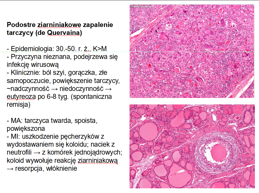 <p>D. podostre zapalenie tarczycy de Quervain - <span>&nbsp;</span>jest to najczęstsza przyczyna bólu tarczycy; jest też nazywana ziarniniakowym zapaleniem tarczycy. W nacieku zapalnym w zależności od etapu choroby obecne są neutrofile i komórki olbrzymie, które fagocytują koloid uwolniony z uszkodzonych pęcherzyków.</p>