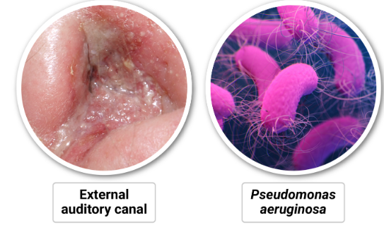 <p>which cranial nerve is most commonly involved in malignant otitis externa?</p>