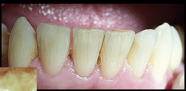 <p>a crack of the enamel without loss of tooth structure</p>