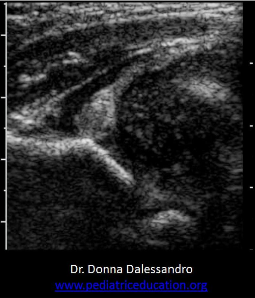 <p>Which statement is true regarding the image displayed?</p><p>A. The alpha angle will significantly exceed 60 degrees which indicates dislocation.</p><p class="p1">B. The infant hip appears normal with normal femoral head location within the acetabulum.</p><p class="p1">C. The alpha angle appears less than 43 degrees and the femoral head coverage is less than 50% which indicates dislocation.</p><p class="p1">D. The beta angle appears less than 43 degrees and the femoral head coverage is less than 50% which indicates dislocation.</p>