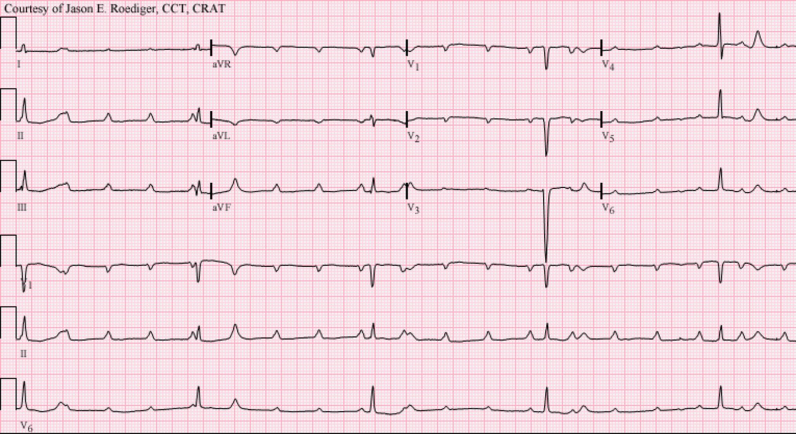 <p>Mobitz type 2 (pic) (type 2 is not wenkebach) and third degree tx.</p>