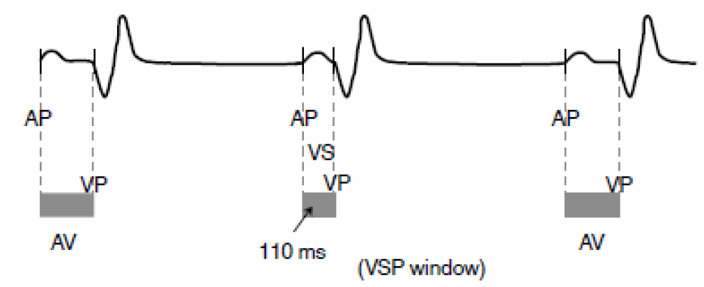 <p>detects crosstalk by monitoring for nonphysiologic ventricular sensed events after an atrial pace. </p><p>If detected, the device will respond by sending a ventricular pace (VP) shortly after the suspected ventricular oversensing</p>