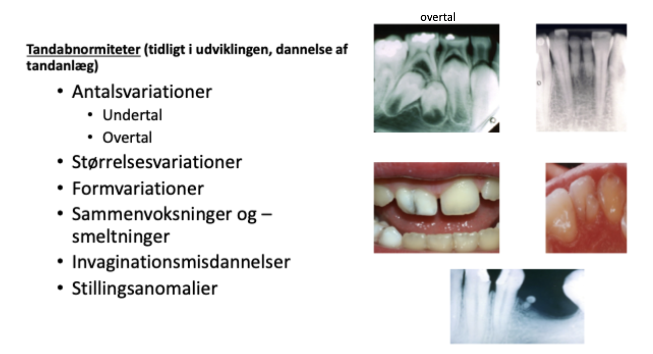 <p>Hypodontia 1-5 tænder, oligodonti 6+, anodonti alle tænder</p><p>Hyperdontia (mesiodens, paramolaris, distomolaris)</p><p>Makrodonti</p><p>Mikrodonti</p><p>Formvariation:</p><ul><li><p>taptand</p></li><li><p>cuspisafvigelser</p></li><li><p>overtallige rødder</p></li><li><p>ektopisk emalje (emaljeudløbere/emaljedråber)</p></li><li><p>Hypercementose</p></li><li><p>taurodonti (øget rodsokkelhøjde)</p></li><li><p>Rhizomeglia dentis (abnorm stor tandrod)</p></li><li><p>Rhizomecria dentis (abnorm lille tandrod)</p></li></ul><p>Sammensmeltninger</p><ul><li><p>Dentes confusi (to tandanlæg vokset sammen)</p></li><li><p>dentes geminati (ufuldstændig spaltning af to tænder, overtallig tand)</p></li><li><p>dentes concreti (cement på to tænder vokset sammen)</p></li><li><p>dens invaginatus (emalje vender ind mod pulpa, ofte 2+2)</p></li></ul><p></p>
