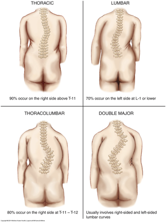 <p>lateral curvature of the spine </p><ul><li><p>causes rib asymmetry </p></li></ul><p></p>