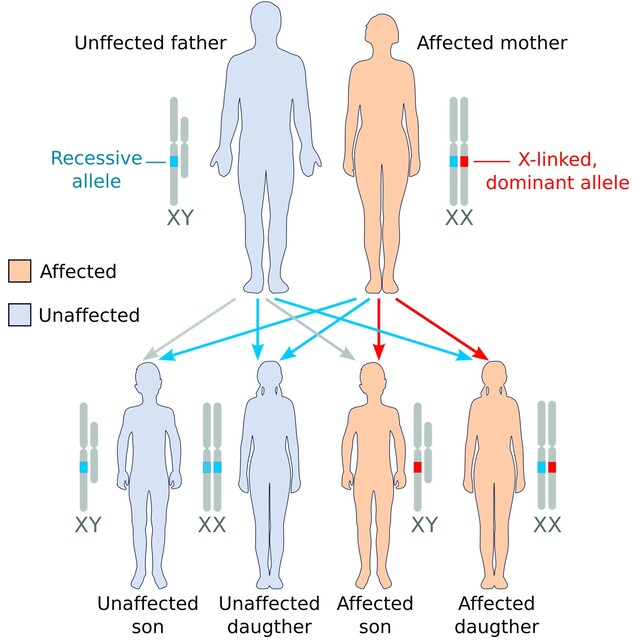<p>Rett syndrome: A rare genetic neurological disorder primarily affecting girls<strong><br>3 possible genotypes for females (XX):</strong><br>XᴿXᴿ-affected (disease)<br>XᴿXʳ-affected (disease)<br>XʳXʳ- unaffected (healthy)<br><strong>2 possible genotypes for males (XY):</strong><br>XᴿY-affected (disease)<br>XʳY-unaffected (healthy)</p>