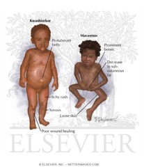 <p>A condition that arises when the body does not get the right amount of vitamins, minerals, and other nutrients to maintain healthy tissues and proper organ function.</p>