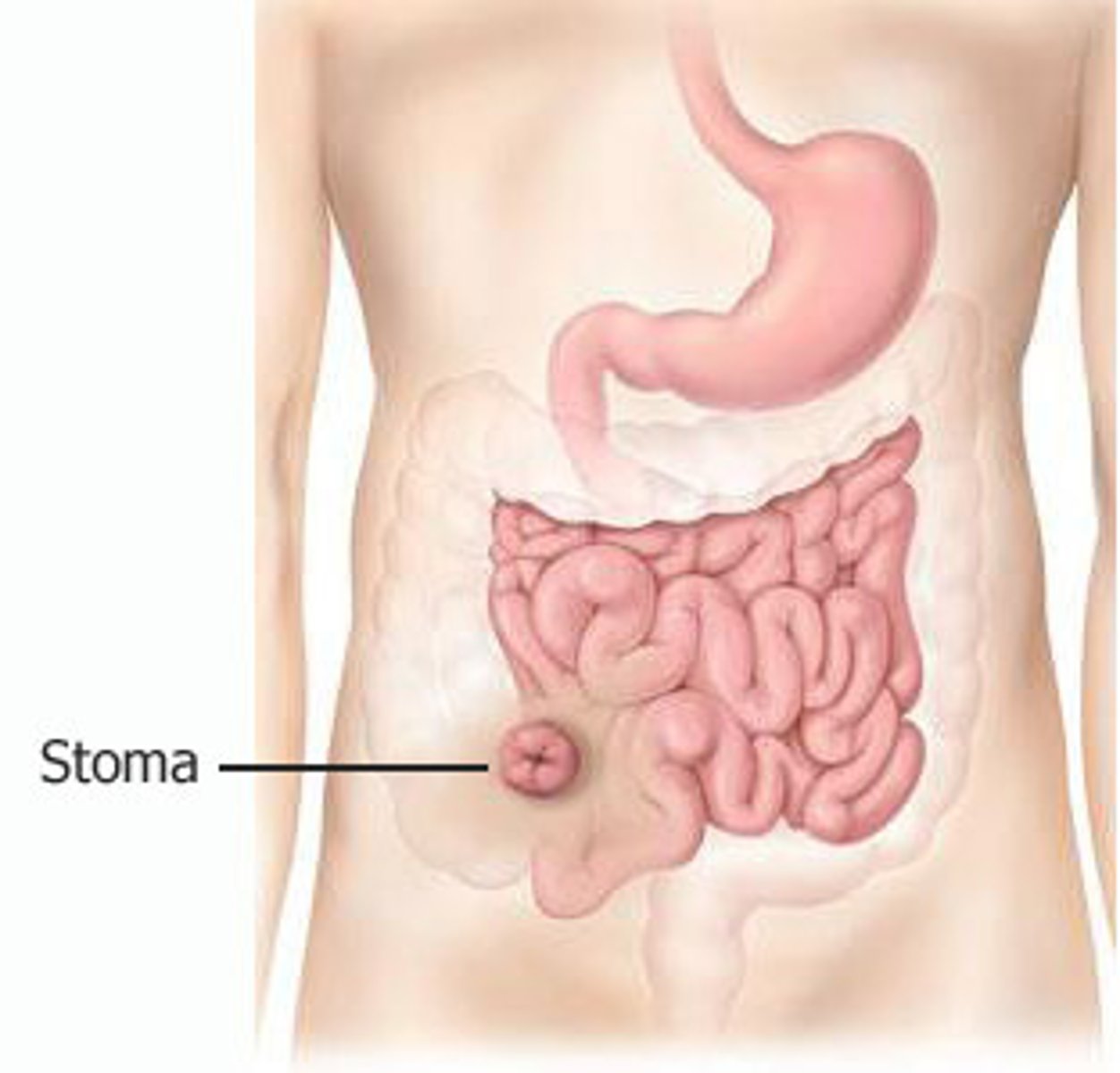 <p>ileostomy</p>