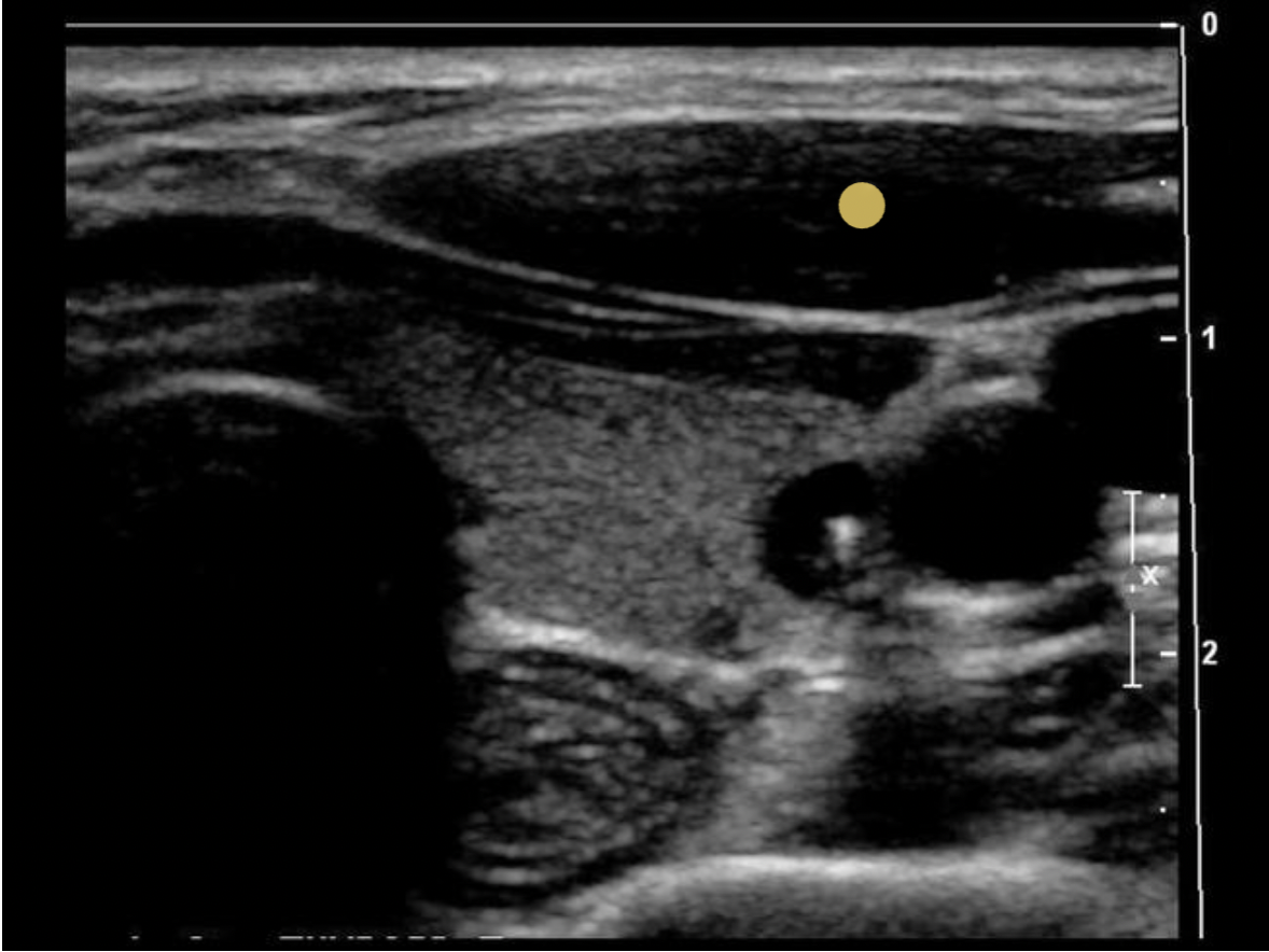 <p>The sternocleidomastoid muscles are anterolateral to the thyroid gland</p>