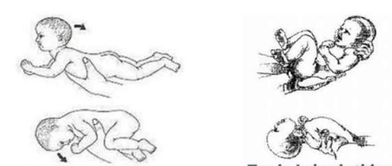 <ul><li><p>primitive reflex - brainstem</p></li><li><p>in prone position with head in midposition, see flexion of extremtiies/increase in flexor tone</p></li><li><p>in supine position see extension of extremities or increase in extensor tone</p></li></ul><p></p>