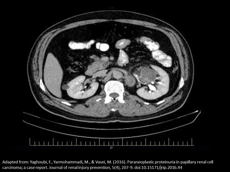 <p>a patient is referred for an abdominal ultrasound due to an abnormal CT scan. The report is not available yet, but the study is in the PACS system. Based on this single CT image, where will you scan to evaluate an abnormality identified on the CT exam?</p>