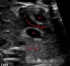 <p>Left ventricular outflow tract</p><p>blood exits the left ventricle into the aorta. </p>