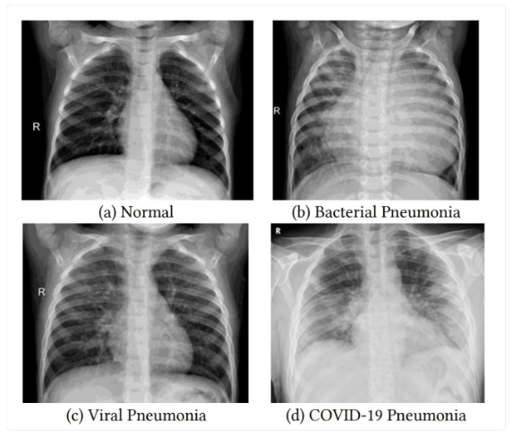 <p>lower resp infection that inflames the alveoli in one or both lungs </p><ul><li><p>lots of causes (CAP, HAP, HCAP, VAP, ARF)</p></li><li><p>can be bacterial, viral, fungal</p></li></ul><p></p>