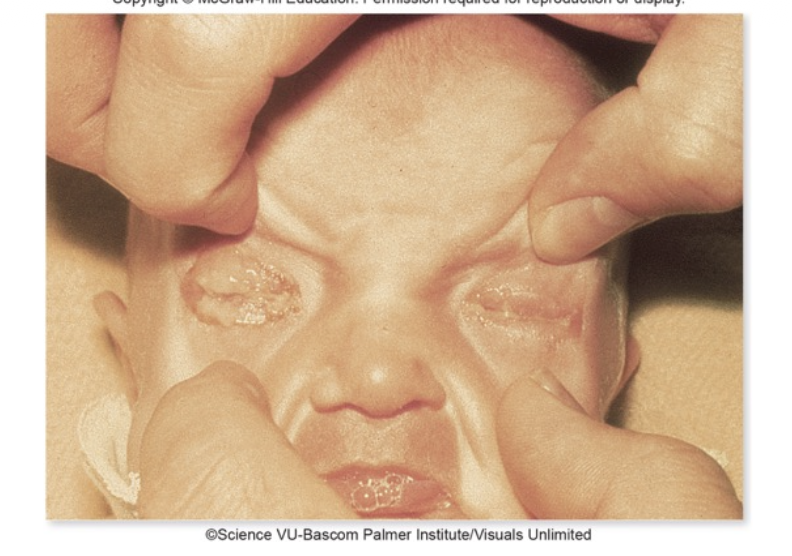 <p>Conjunctivitis</p>
