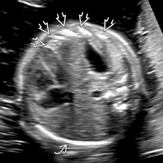 <p>diaphragm fails to close </p><ul><li><p>stomach or liver located in thorax </p></li><li><p>mediastinal shift </p></li><li><p>left sided more common</p></li></ul><p></p>