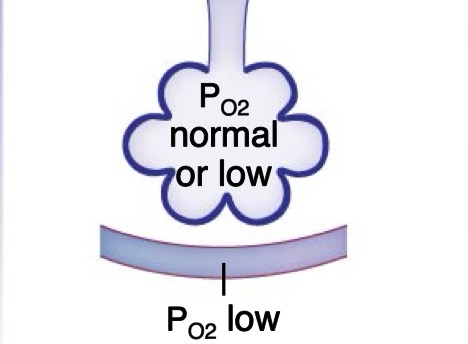 <p>Thickened alveolar membrane slows gas exchange; loss of lung compliance may decrease alveolar ventilation → low PO2</p><ul><li><p>due to dirty air (ex. working in a minefiled)</p></li><li><p>lung grows thicker, increasing diffusion distance —- supposed to be simple squamous epithelium</p></li></ul><p></p>