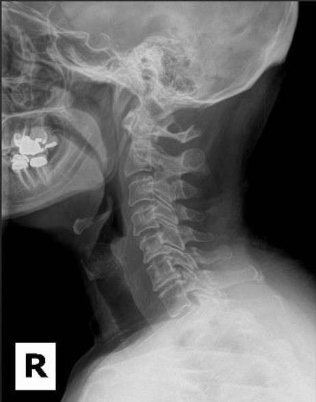 <p>Is this film of diagnostic quality (Lateral Cervical)</p>
