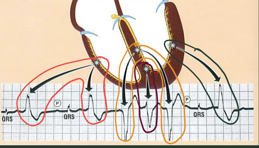 <p>What are multifocal PVC’s?</p>