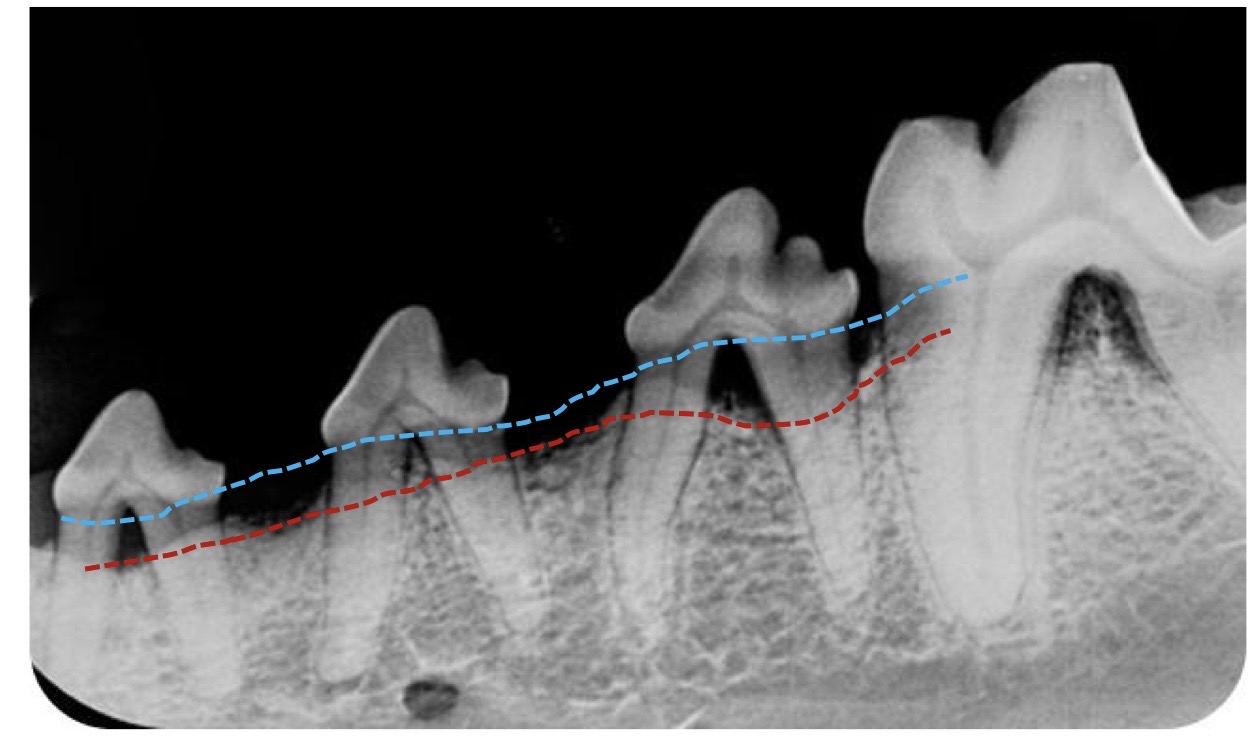 <p>what bone loss pattern is this?</p>