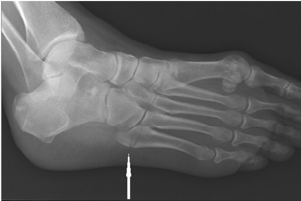 <p>Fracture of diaphysis of 5th metatarsal, AP/Oblique/Lateral foot views with foot fully dorsiflexed required</p>