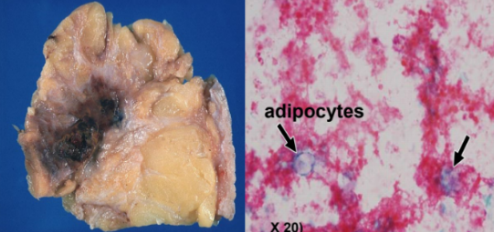 <p>What pathology? What stage (Acute/ Subacute)?</p>
