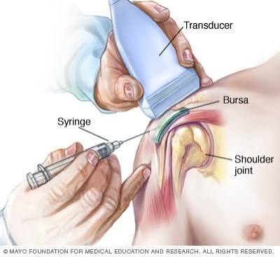 <p>fluid aspiration</p><p>activity changes</p><p>anti-inflammatories</p><p>corticosteroid injections</p><p>recurrent-surgical removal of bursa</p>