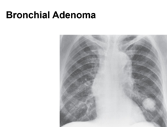 <p>This x-ray image indicates what pathology?</p>