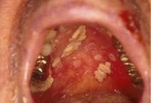 <p>CASE: A patient receiving anticancer therapy develops painful oral ulcerations and easy oral bleeding. Which two oral complications were emphasized as the most likely complications of cancer treatment?</p>