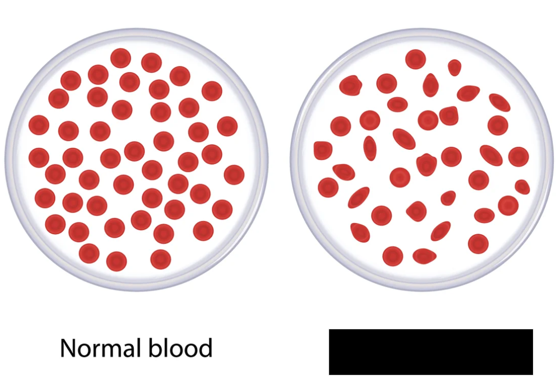 <p><span style="background-color: transparent;">A disease that affects hemoglobin, the oxygen-carrying molecule in the blood. Individuals with the disease may have red blood cells that differ in color and shape, therefore being less efficient in carrying gases. Unusual cell types include “target” cells, “teardrop” cells, microcytes, and red blood cells with nuclei. Causes fatigue, weakness, swelling of the abdomen, and jaundice. May require blood transfusions.</span></p>