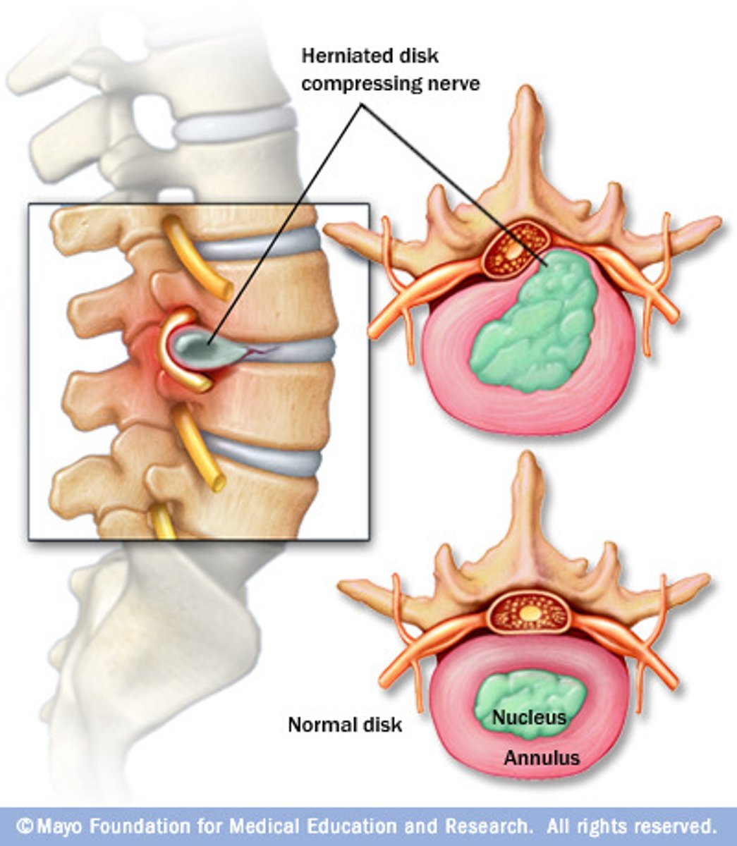 <p>laterally, inner portion comes out</p>