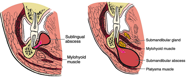 <p>Lingual perforation</p>