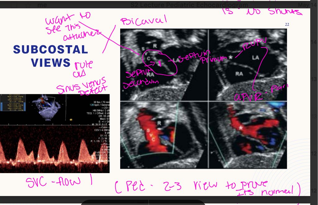 <p>What is the probe indicator direction in subcostal SAX views?<br>→ 6 o’clock</p><p>What venous structures are evaluated in subcostal SAX views?<br>→ SVC and IVC</p><p>What pulmonary vein is specifically evaluated in subcostal SAX views?<br>→ Right upper pulmonary vein</p><p>What septal structure is evaluated in subcostal SAX views?<br>→ Atrial septum</p><p>1st start off with the Bicaval view, AO, RVOT, The ventricle level</p><p>RIGHT to LEFT SWEEP</p><p>rule out sinus venous defects</p>