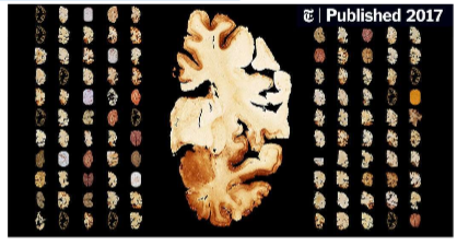 <p>In 2017, Dr. McKee’s group published a study that made the NY Times: “A neuropathologist has examined the brains of 111 N.F.L. players — and 110 were found to have C.T.E., the degenerative disease linked to repeated blows to the head.</p>