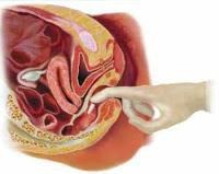 <p>Drugs administered rectally as a suppository mixed with a waxy substance that dissolves in the rectum.</p>