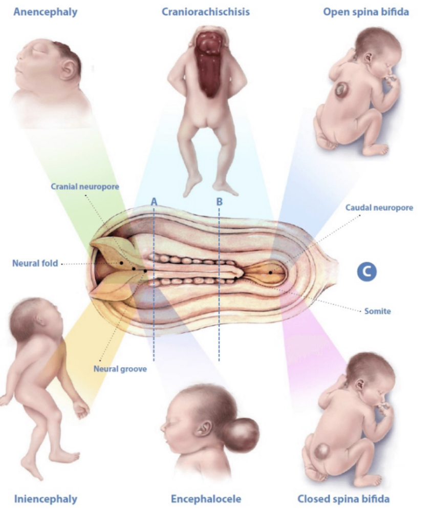 <p>Non-closure of the cranial neuropore; non-formation of the cranial vault and brain. Non-compatible with life</p><p></p>