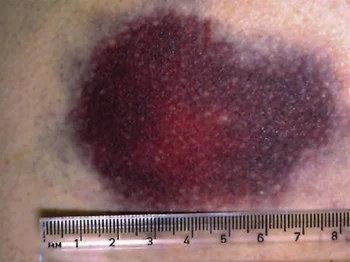 <p>Ecchymosis (vascular lesion)</p>