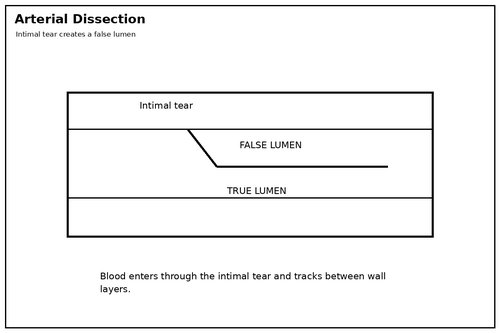 <p><span>Blood may flow through the normal lumen and through a false channel created within the vessel wall.</span></p>