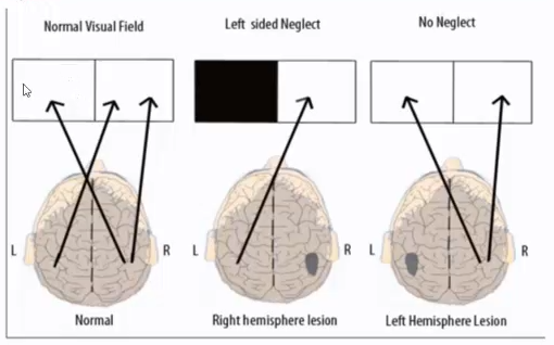 <p>Since the right hemisphere is responsible for directing attention either side, damage to the right hemisphere will create hemispatial neglect on the left side</p>