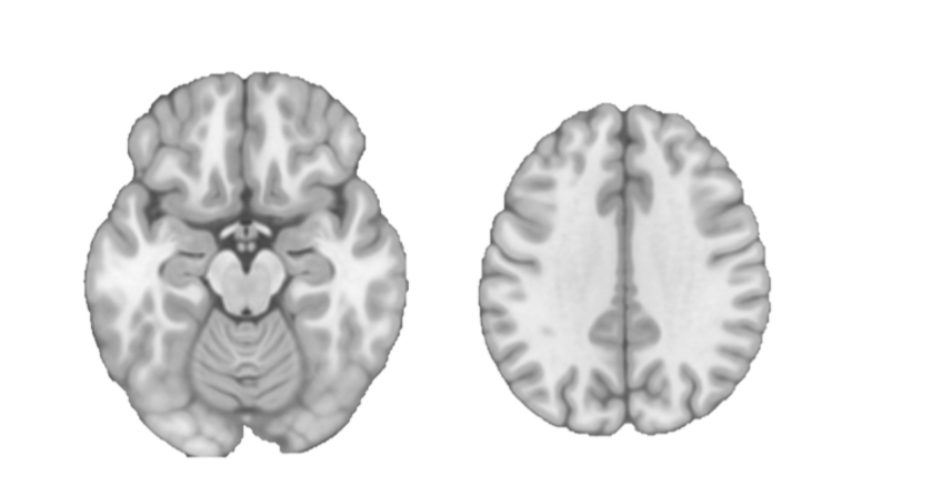 <p>which “plane of section” is displayed? A) Axial B) Sagittal C) Coronal </p><p>Which is further dorsal? Left or Right </p>