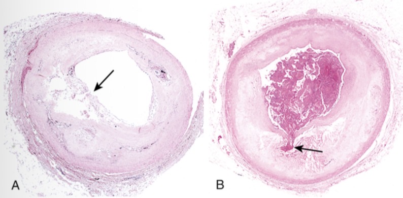 <p>Placa aterosclerótica </p><p>Izquierda: ateroma lipidico </p><p>Derecha: ateroma fibroso </p>