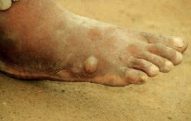 <p>What disease is this? What parasite causes it?</p>