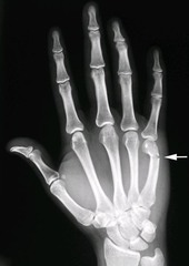 <p>Transverse fracture that extends through the metacarpal neck (commonly seen on 5th metacarpal)</p>