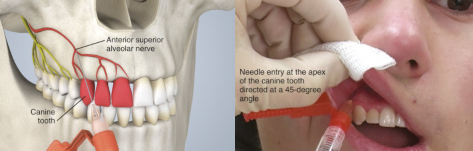<p>What landmarks are anesthetized with an ASA block?</p><p>teeth & tissues </p>