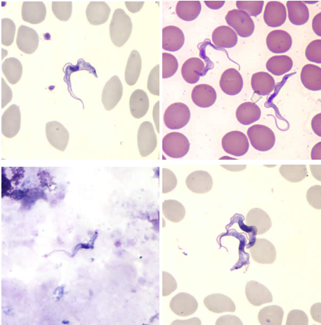 <p>Trypanosoma brucei spp., trypomastigote</p><p>Disease: <u>African sleeping sickness</u></p><p>Vector: <u>Tsetse fly</u></p><p>Transmission: <u>Bite of fly</u></p><p>Infective stage: <u>Metacyclic trypomastigote</u></p><p>Diagnostic stage: <u>Trypomastigote</u></p><p>Treatment: <u>Suramin sodium</u></p>