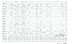 <p>a pattern of chaotic high-voltage slow waves, spikes, and polyspikes</p><p>-seen in west syndrome</p>