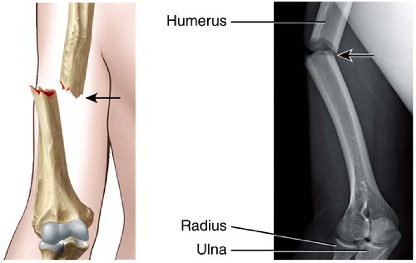 <p>whether fracture extends thru skin</p><p>*prone to infection; urgent tx</p>