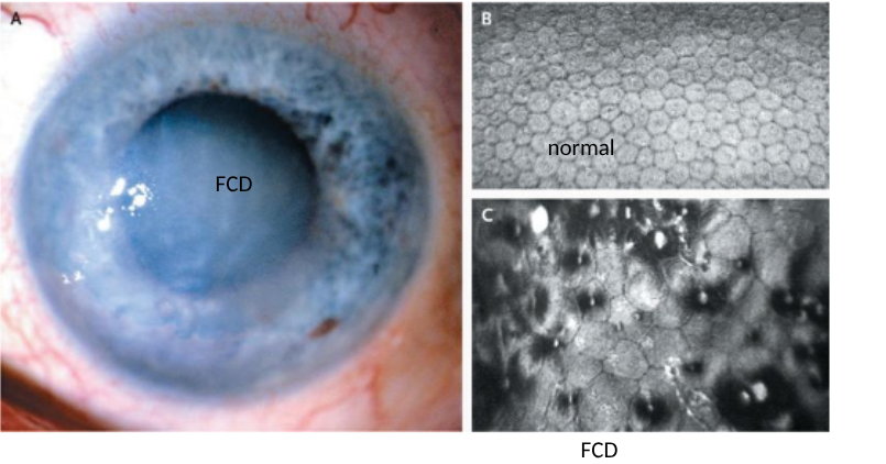 <p>glare/blurred vision upon waking (improves over next hours)</p><p></p><p>causes</p><p>corneal endothelial cell loss form guttata (deposits on cornea) </p><p>compromised corneal endothelial pump</p><p>corneal oedema (inner corneal cells die causing fluid buildup and corneal swelling)</p><p></p><p>treatment</p><p><span style="background-color: inherit; line-height: 20.7px; color: windowtext;">Eye drops for mild swelling to reduce corneal swelling&nbsp;</span><span style="line-height: 20.7px; color: windowtext;">&nbsp;</span></p><p class="Paragraph SCXO180145075 BCX0" style="text-align: left;"><span style="line-height: 20.7px; color: windowtext;">&nbsp;</span></p><p class="Paragraph SCXO180145075 BCX0" style="text-align: left;"><span style="background-color: inherit; line-height: 20.7px; color: windowtext;">Or replacement of damaged endothelial cell layer&nbsp;</span><span style="line-height: 20.7px; color: windowtext;">&nbsp;(corneal transplant)</span></p>