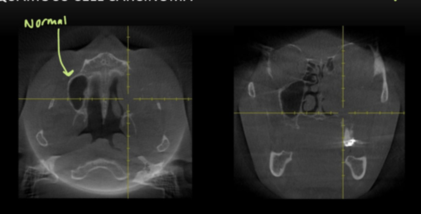 <p>Soft tissue mass has destroyed everything around it --> very aggressive</p>