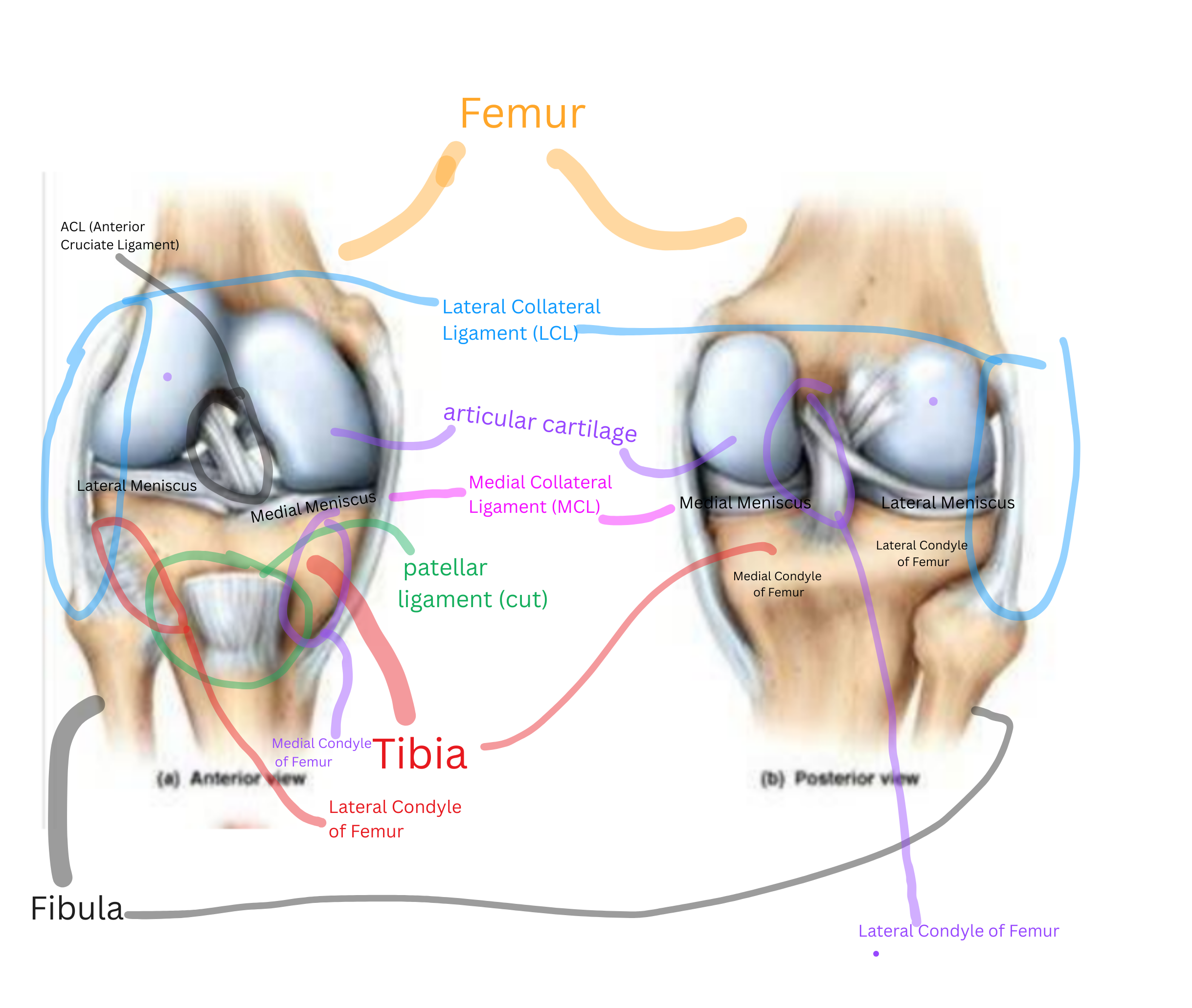<p>Femur: thigh bone<br>Tibia: shin bone<br>Fibula: thin outer lower-leg bone (doesn't bear much weight)<br>Lateral condyle of femur & medial condyle of femur: the two rounded knobs at the bottom of the femur that rest on the tibia<br>Articular cartilages: smooth cushions covering the bone ends<br>Medial meniscus & lateral meniscus: cartilage pads that act as shock absorbers<br>ACL (anterior cruciate ligament): stops the shin bone from sliding too far forward<br>PCL (posterior cruciate ligament): stops the shin bone from sliding too far backward<br>Medial collateral ligament & lateral collateral ligament: stop the knee from bending side to side<br>Patellar ligament (cut): connects the kneecap to the shin bone</p>